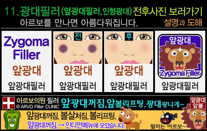 앞광대필러,광대앞필러,인형광대필러,광대필러전후사진