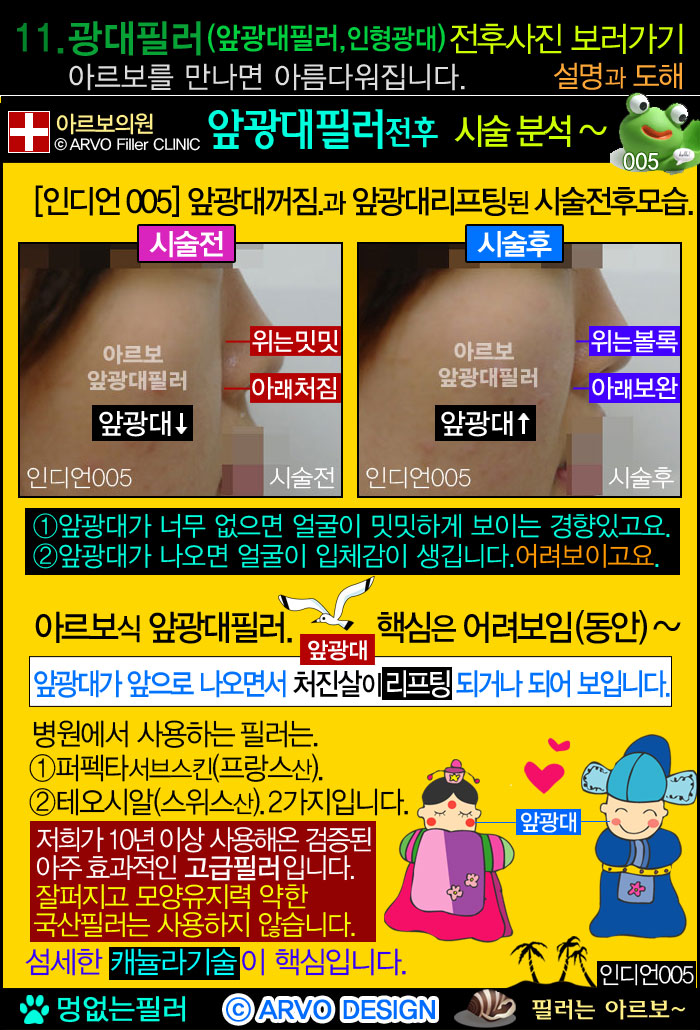 앞광대필러,광대앞필러,인형광대필러,광대필러