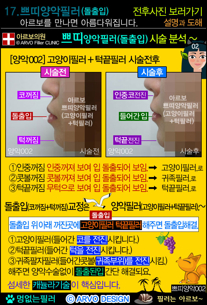 돌출입필러3가지,돌출입필러,쁘띠양악필러,고양이필러,턱끝필러,쁘띠양악필러전후설명